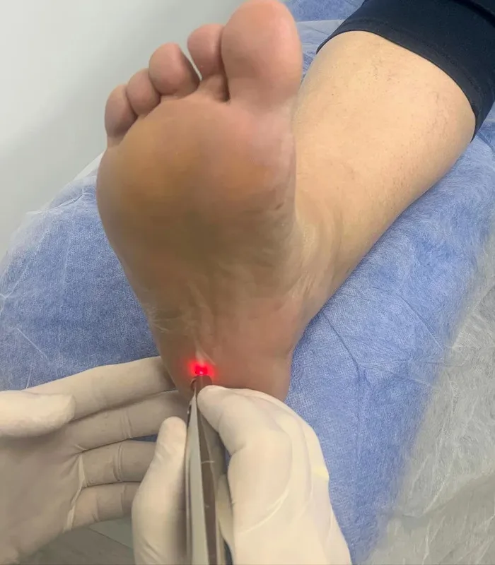 Tratamiento Laser